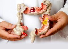 علایم و نشانه‌های سرطان روده بزرگ را بشناسیم