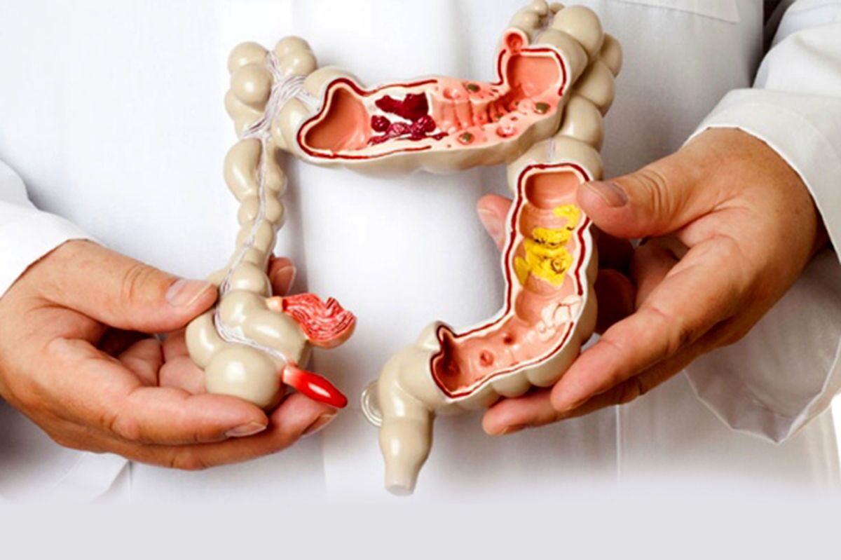 علایم و نشانه‌های سرطان روده بزرگ را بشناسیم