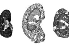 یک ترکیب دارویی امیدبخش برای کوچک کردن کیست‌های کلیه