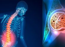 راهکار‌های موثر برای جلوگیری از ابتلا به پوکی استخوان